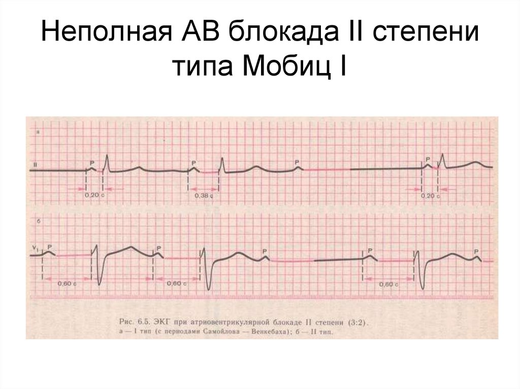 Ав блокада 2 степени. АВ блокада 2 степени 1 типа Мобиц. АВ блокада 1 степени Мобиц 1. Неполная АВ блокада 2 степени 2 типа. Неполная атриовентрикулярная блокада 2 степени.