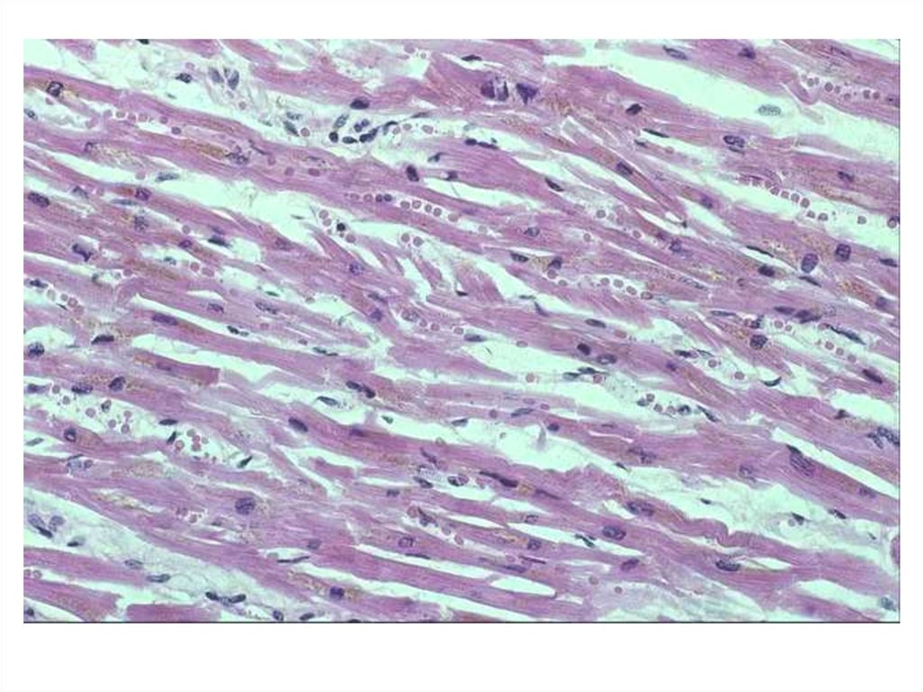 Дистрофия миокарда. Дистрофия миокарда гистология. Тигровое сердце гистология. Жировая дистрофия миокарда гистология. Тигровое сердце патанатомия.
