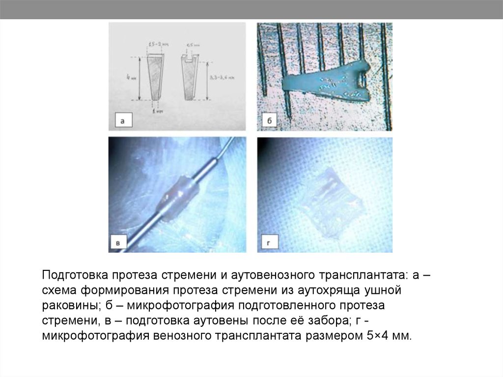 Стапедопластика отзывы. Инструменты для забора трансплантата. Аутовенозный трансплантат. Методы стапедопластики. Стапедэктомия со стапедопластикой по поршневой методике.