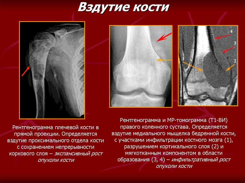 Образование кости. Образование плечевой кости рентген. Вздутие кости на рентгенограмме. Вздутие плечевой кости.