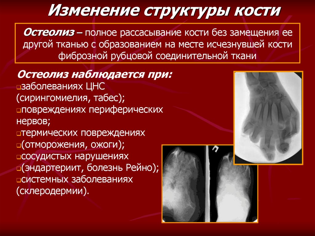 Изменение структуры кости. Остеолиз рентген признаки. Остеолиз костной ткани.
