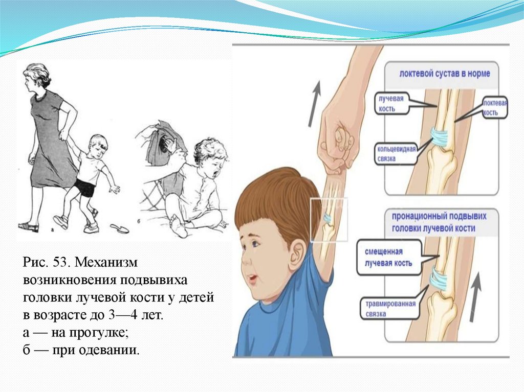 Вывих локтевого сустава карта вызова