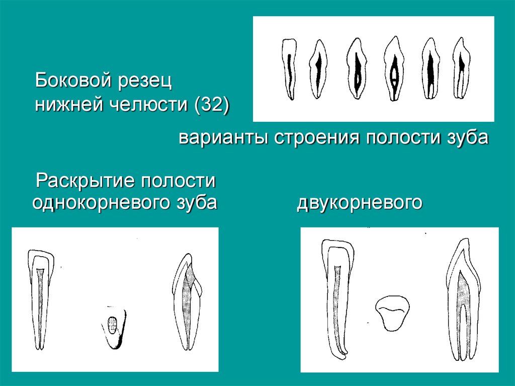 Зуб боковой резец. Боковой латеральный резец верхней челюсти. Центральный резец нижней челюсти полость зуба. Центральный резец нижней челюсти анатомия. Боковой латеральный резец нижней челюсти.