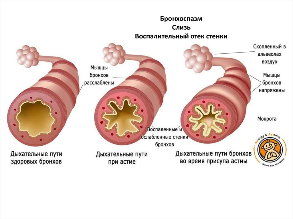 Презентация на тему бронхиальной астмы