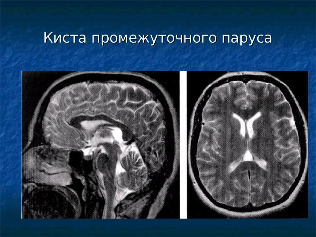 Мр картина кистовидной перестройки эпифиза