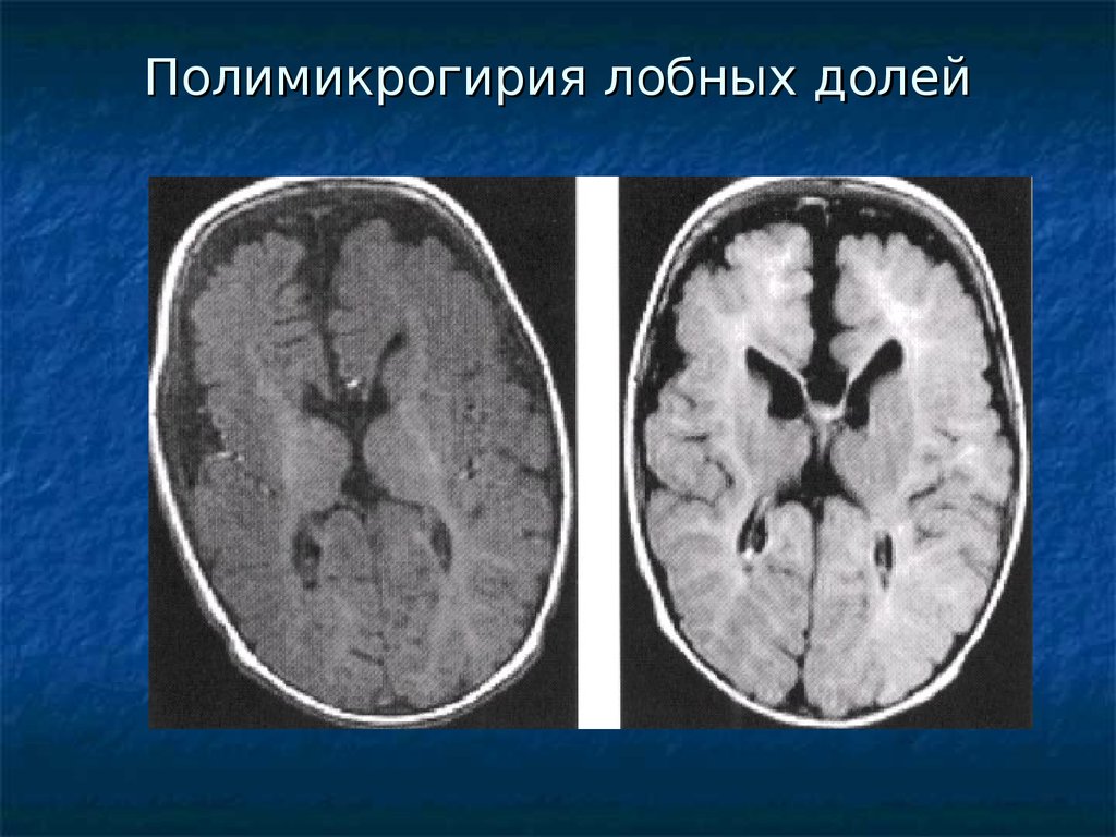 Пахигирия. Лиссэнцефалия-пахигирия. Перисильвиарная полимикрогирия. Микрогирия головного мозга. Билатеральная полимикрогирия.