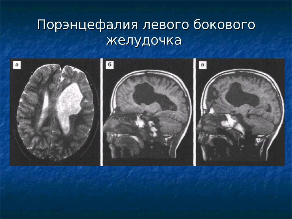 Порэнцефалическая киста