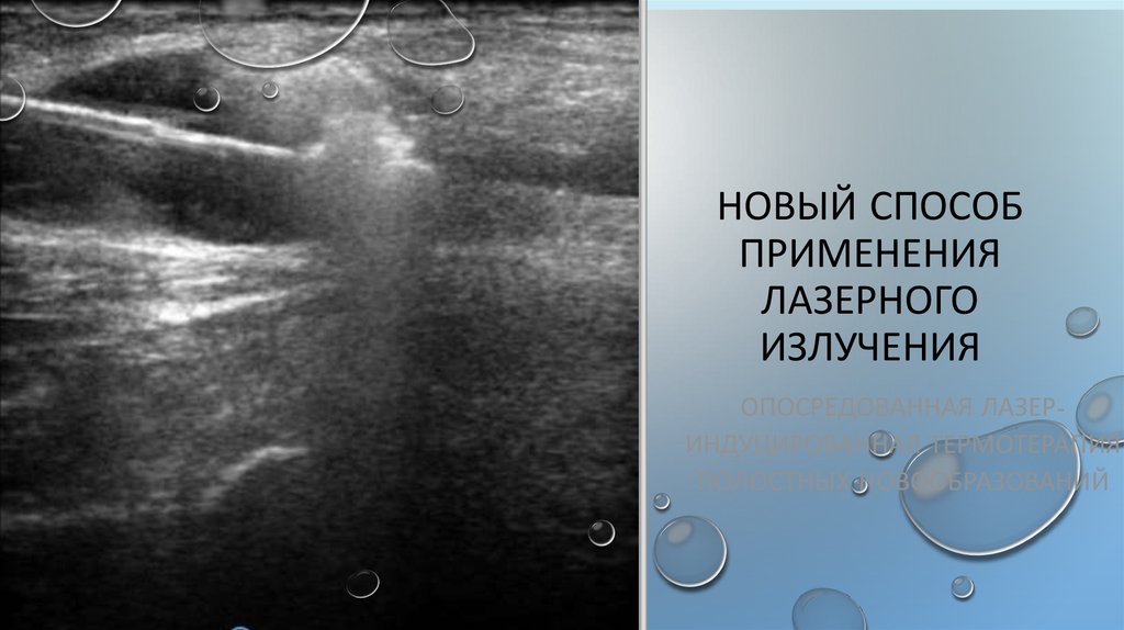 Новый способ применения лазерного излучения