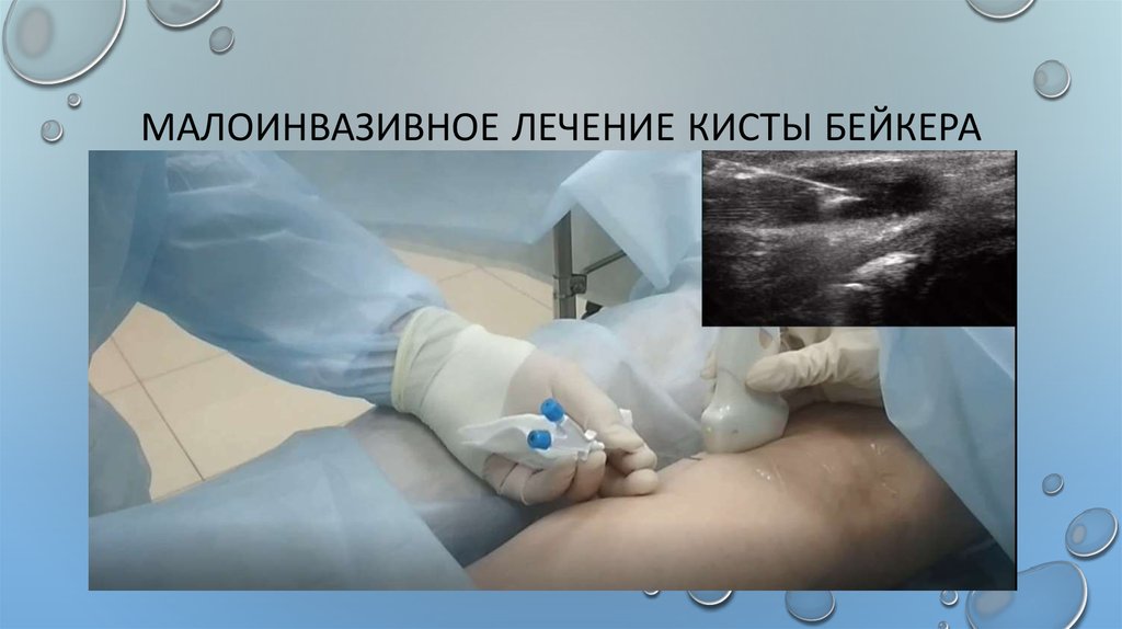 Малоинвазивное лечение кисты бейкера