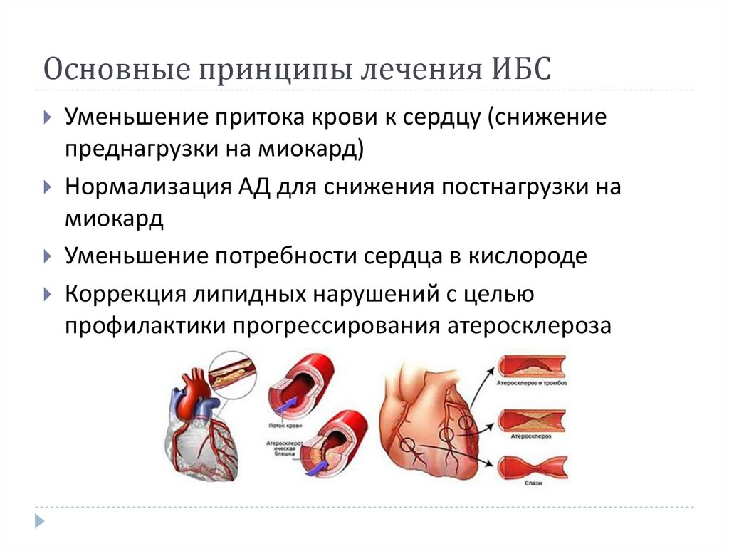 Ишемия отзывы. Принципы лечения ишемической болезни сердца. Основные принципы терапии ишемической болезни сердца.. Принципы лечения больных ишемической болезнью сердца. Ишемическая болезнь сердца план лечения.