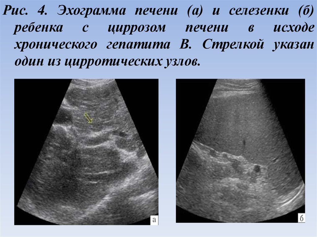 Селезенка при циррозе печени. Живот при циррозе печени. Симптоматология гепатитов и циррозов печени. Криптогенный цирроз печени. Цирротическая трансформация печени.
