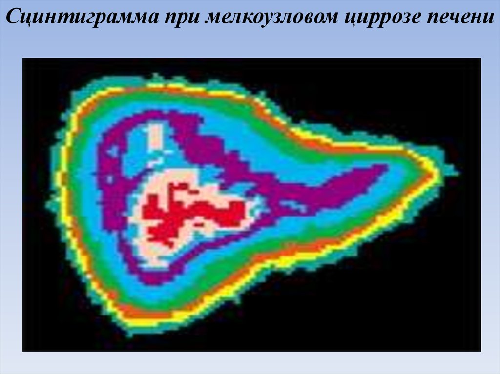 Сцинтиграмма является изображением