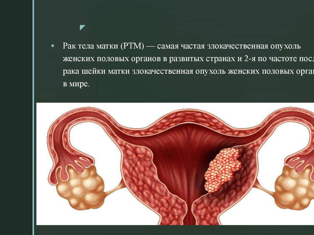 Клиническая картина рака тела матки