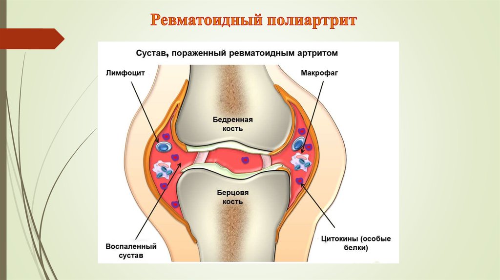 Ревматический полиартрит презентация