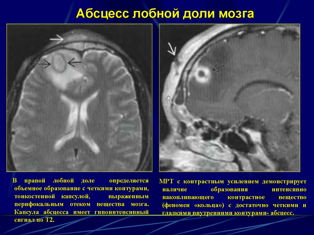 Абсцесс мозга симптомы. Абсцесс головного мозга кт. Кт при абсцессе головного мозга. Риногенный абсцесс головного мозга. Абсцесс лобной доли мозга симптомы.