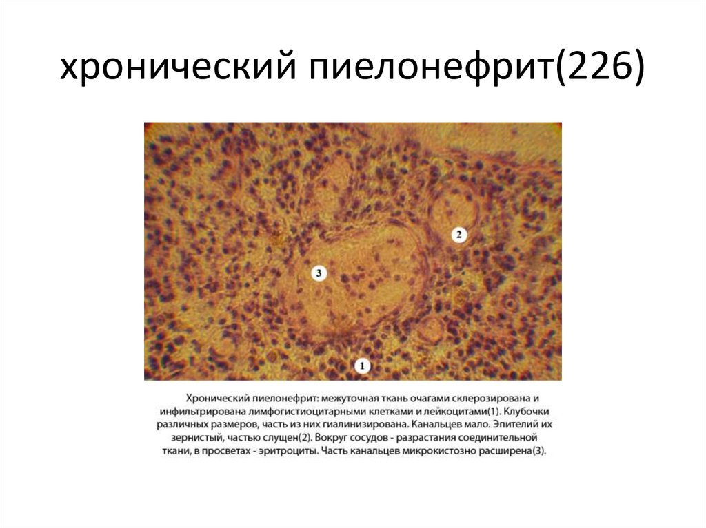 хронический пиелонефрит(226)