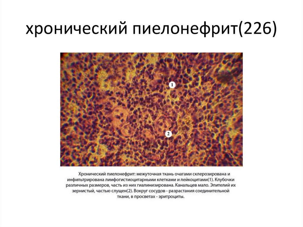 хронический пиелонефрит(226)