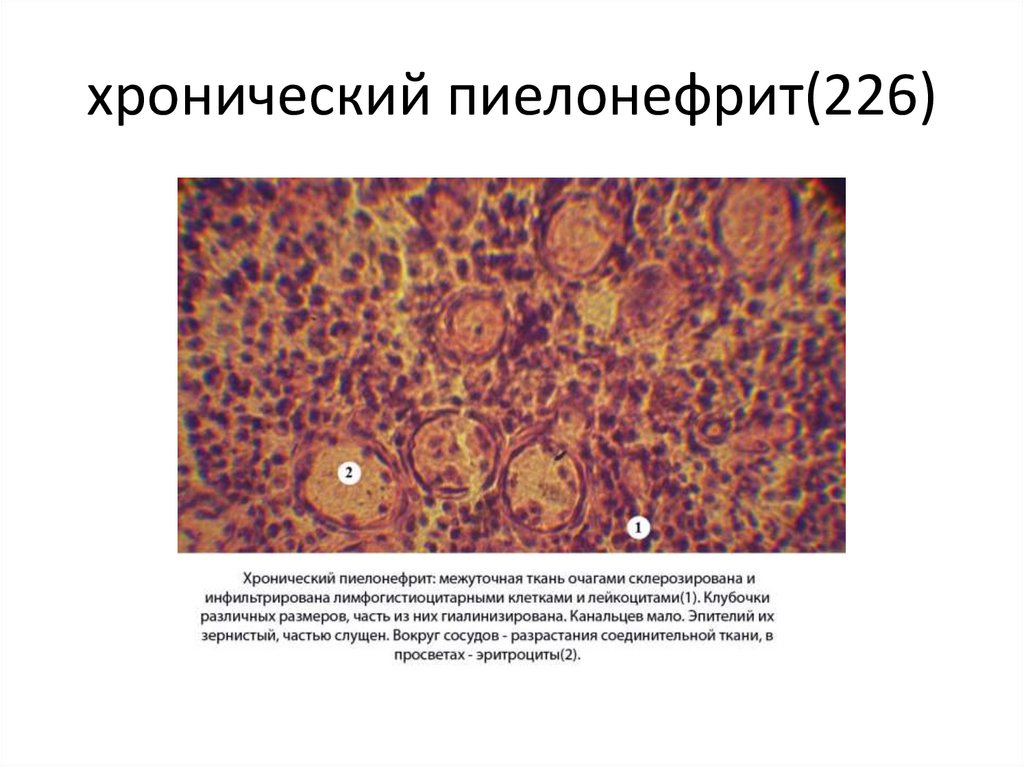 хронический пиелонефрит(226)