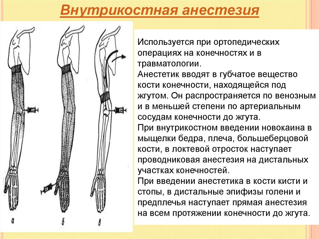 Наркоз при полостной операции. Методы анестезии. Анестезия при операции. Анестезия в травматологии. Виды анестезии при операциях.