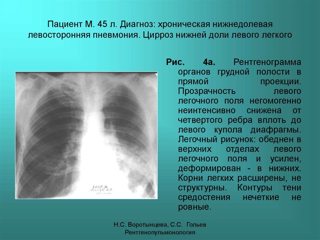 Гипостатические изменения в легких. Нижнедолевая очаговая пневмония рентген. Левосторонняя нижнедолевая пневмония рентген. Левосторонняя нижнедолевая пневмония рентгенограмма. Правосторонняя нижнедолевая очаговая пневмония рентген.