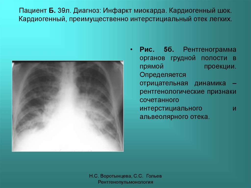 Усиление легочного рисунка за счет интерстициального компонента