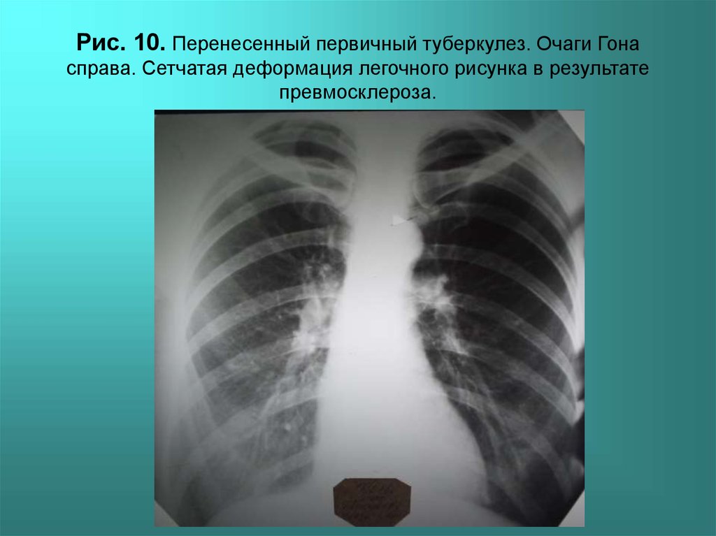 Сетчатые легкие. Первичный туберкулезный комплекс легких рентген. Первичный туберкулез рентген. Туберкулема и очаг гона.