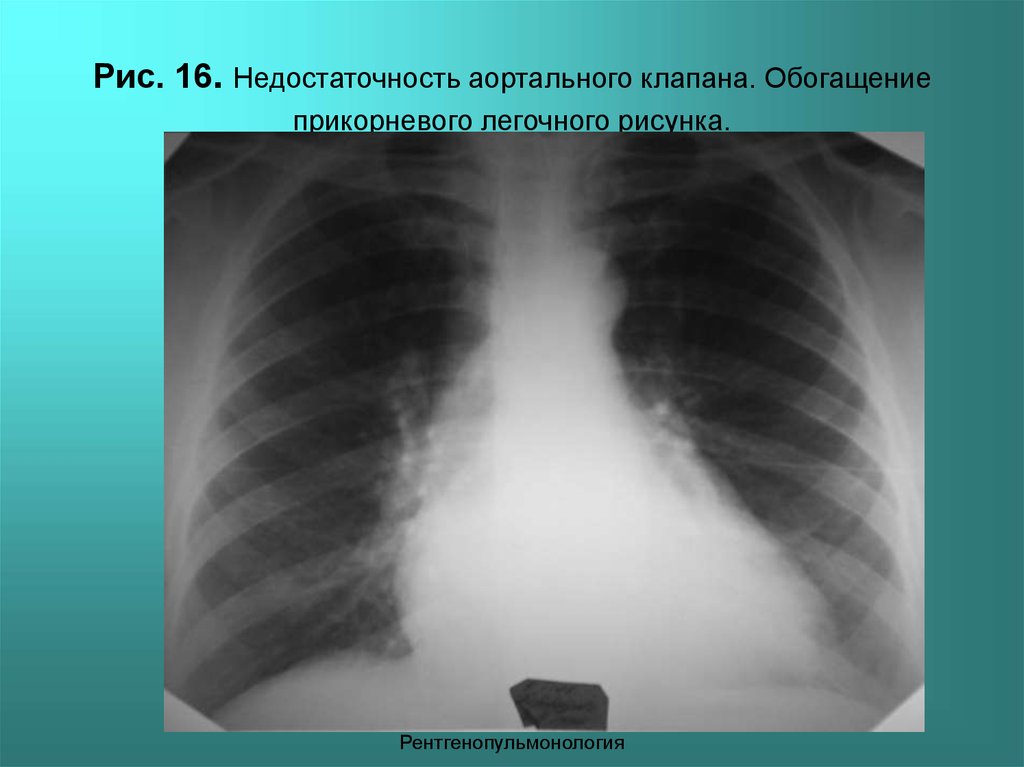 Легочный рисунок усилен и обогащен