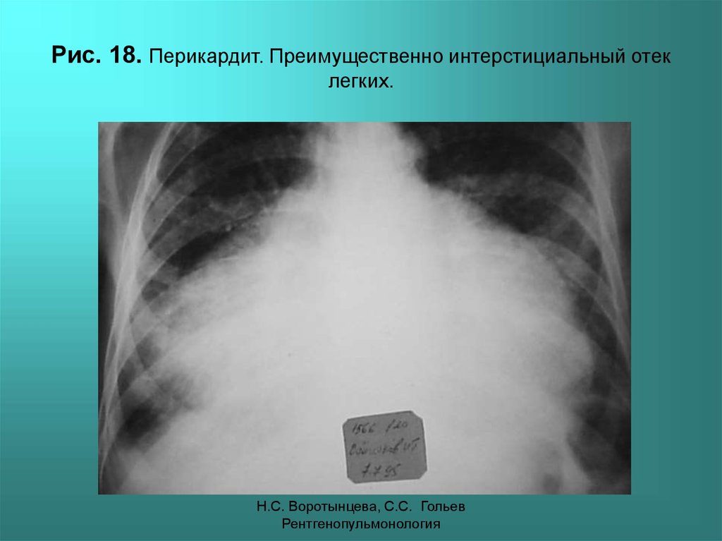 Интерстициальный легочный рисунок. Интерстициальный отек легкого. Интерстициальный отек легких. Патология легочного рисунка. Интерстициальный отек легких кт.