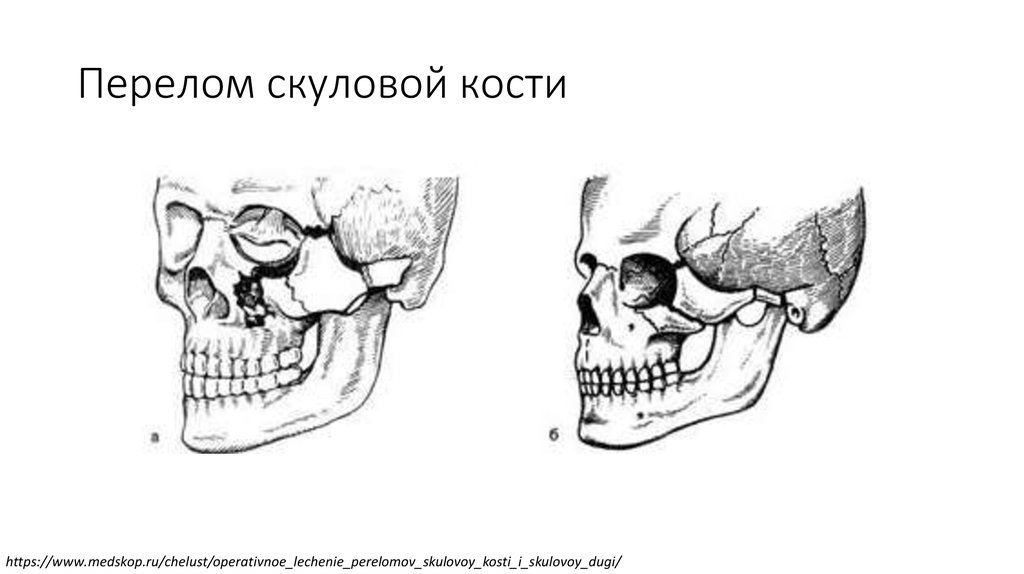 Скуловая дуга картинки