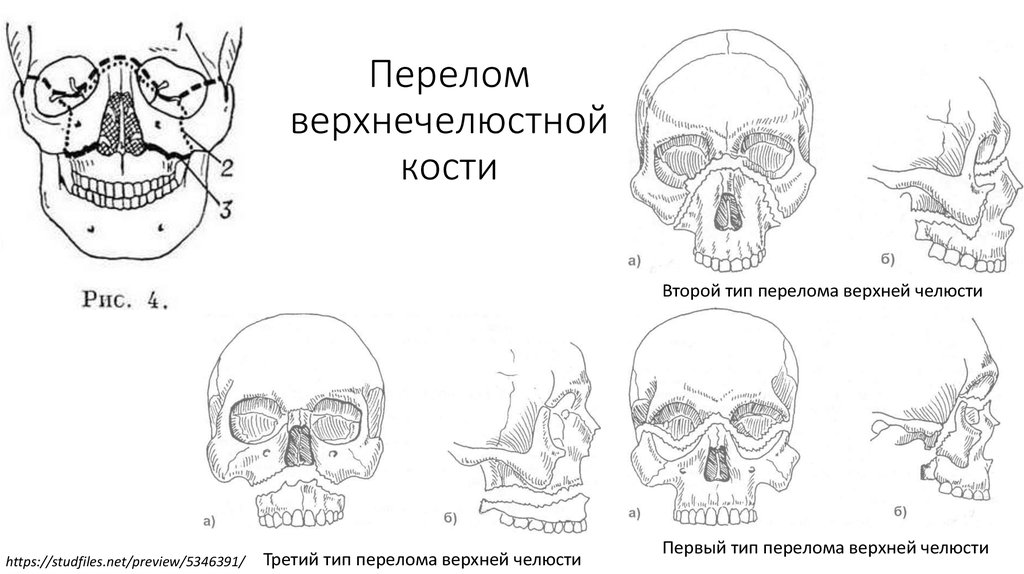 Перелом верхней челюсти карта вызова смп - 94 фото