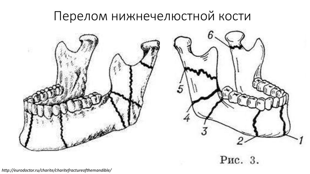 Нижнечелюстная кость. Перелом нижнечелюстной кости. Нижнечелюстная кость кратко. Наружные нижнечелюстные выступы.