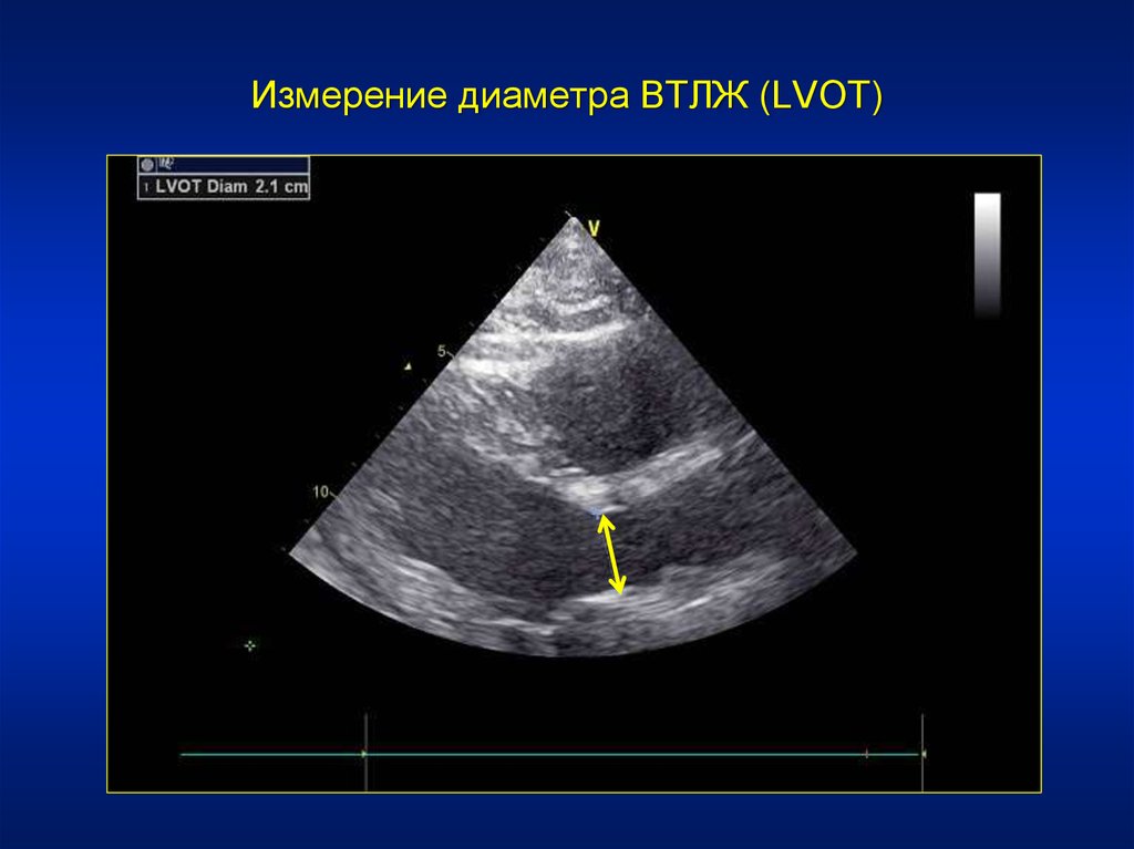 Аортальный клапан на узи