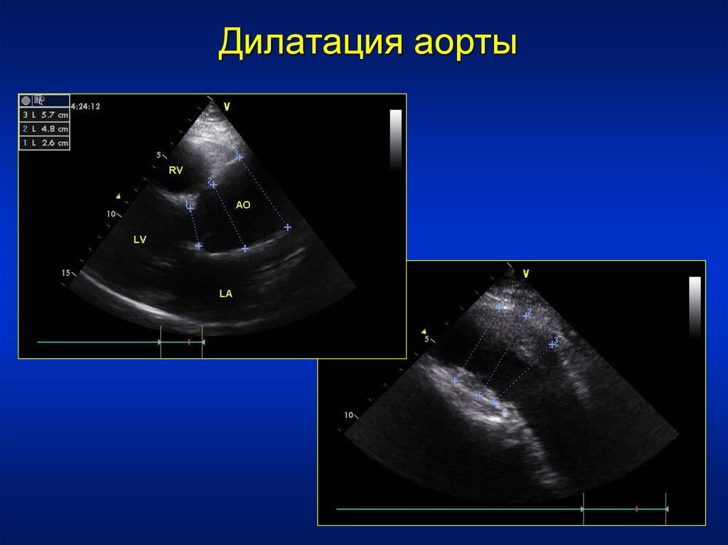 Дилатация сердца. Дилатация восходящей аорты. Расширение корня аорты.