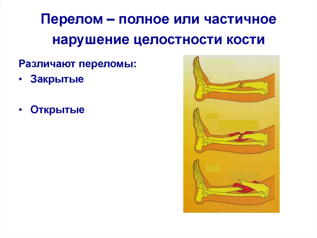 Презентации на тему переломы