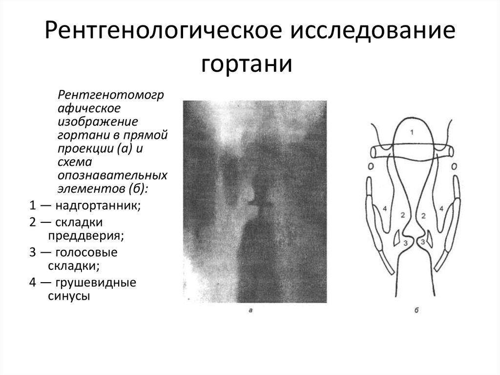 Эктопия щитовидной железы. Рентгенограмма гортани в прямой проекции. Рентген гортани в боковой проекции. Глотка рентген анатомия. Рентген анатомия гортани.