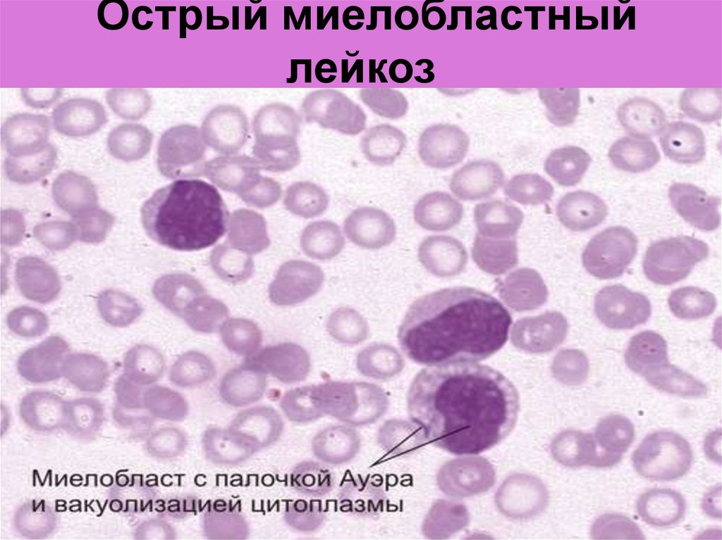 Опухоль клеток крови