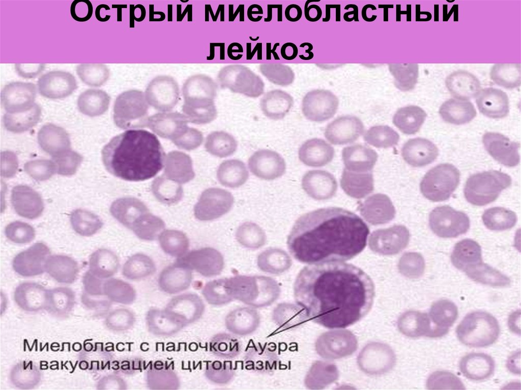 Болезнь ходжкина картина крови