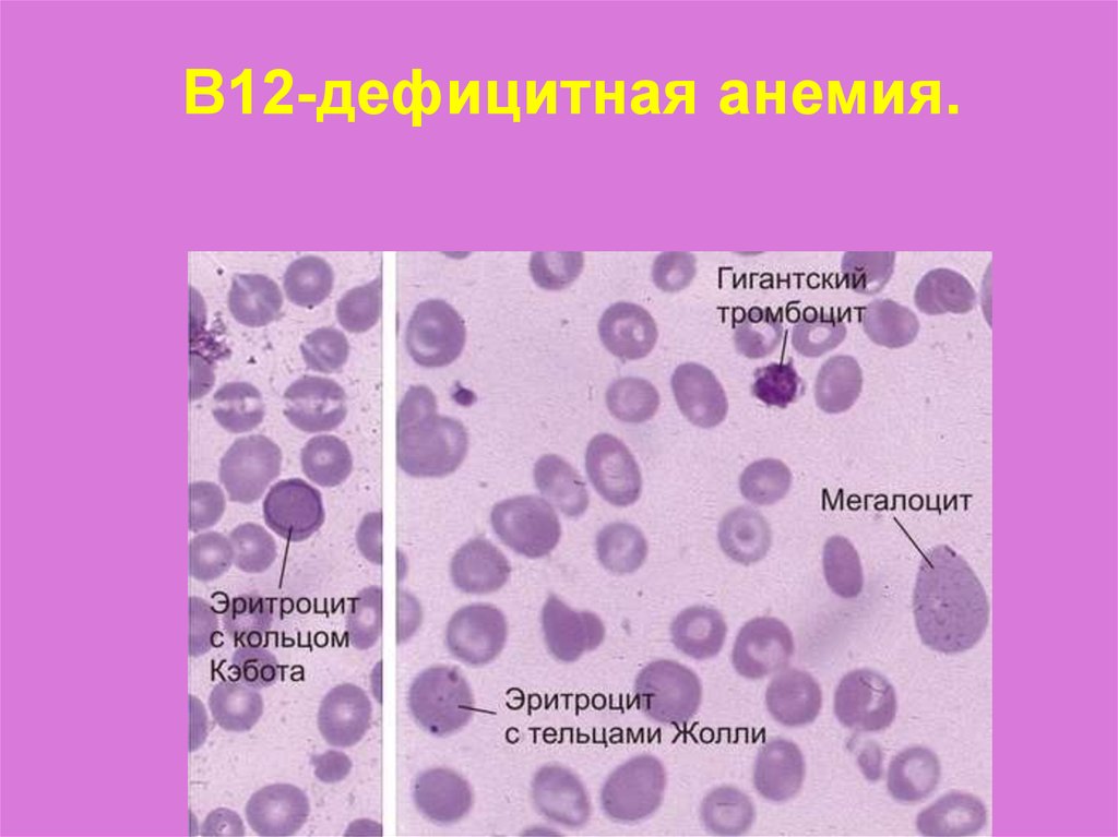 Болезнь ходжкина картина крови