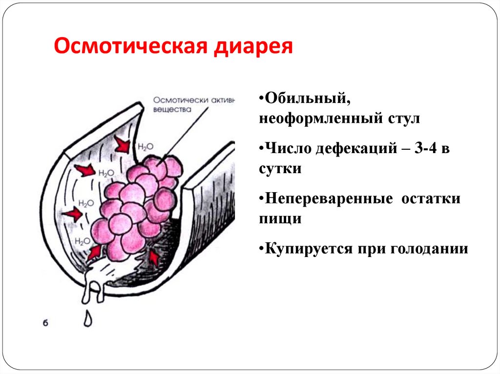 Диарея что это. Осмотическая диарея механизм развития. Осмотическая диарея патогенез. Гиперосмолярная диарея механизм развития. Секреторный Тип диареи механизм.