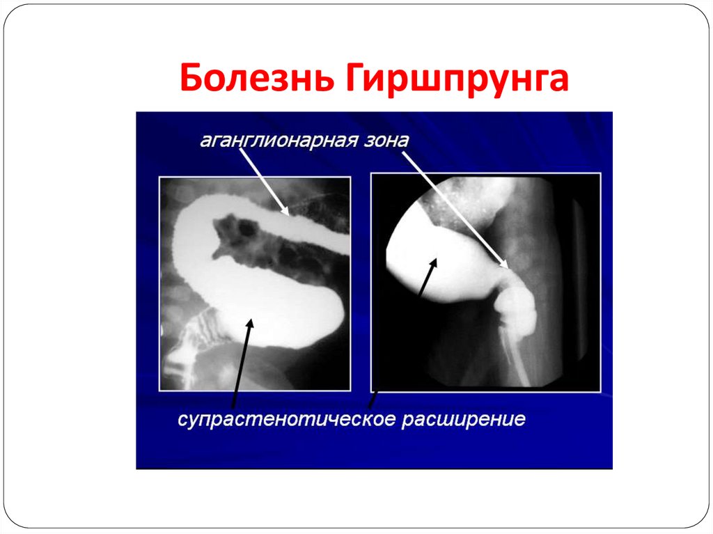 Схема изменений толстой кишки при болезни гиршпрунга