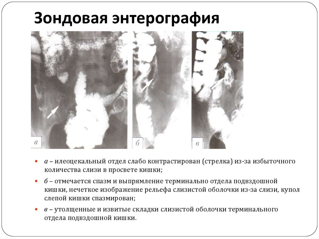 Энтерография. Зондовая энтерография. Кт энтерография тонкого кишечника. Зондовая энтерография кишечник. Кт зондовая энтерография.