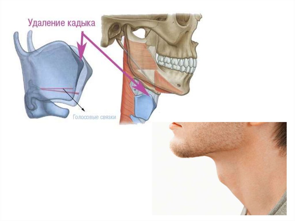 Удаляют ли кадык