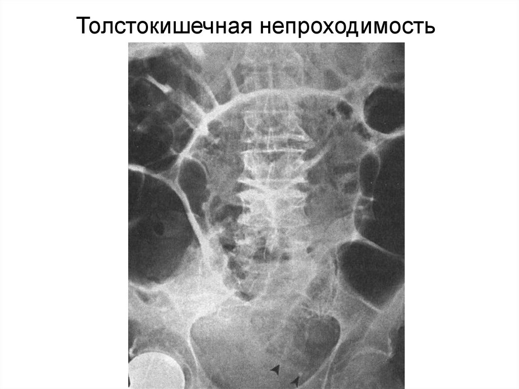 Кишечные уровни. Тонкокишечная непроходимость рентген. Кишечная непроходимость толстокишечная рентген. Толстокишечная непроходимость обзорный снимок. Тонкокишечная непроходимость и Пассаж бария рентген.