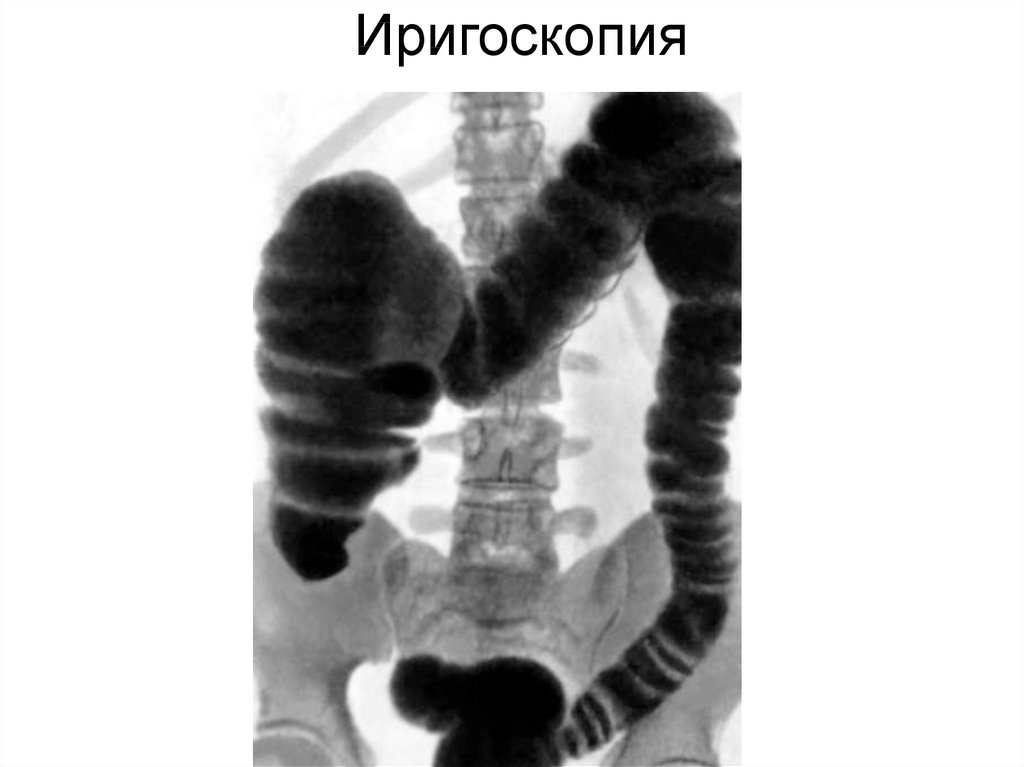 Ирригоскопия кишечника что это. Рентгенологическое исследование Толстого кишечника (ирригоскопия).. Ирригоскопия Толстого кишечника рентген. Исследование толстой кишки ирригоскопия. Обследования кишечника ирригоскопия.