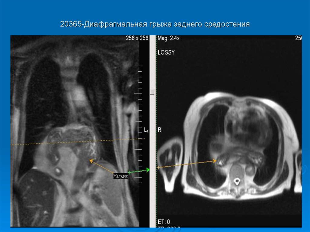 Врожденная диафрагмальная грыжа презентация