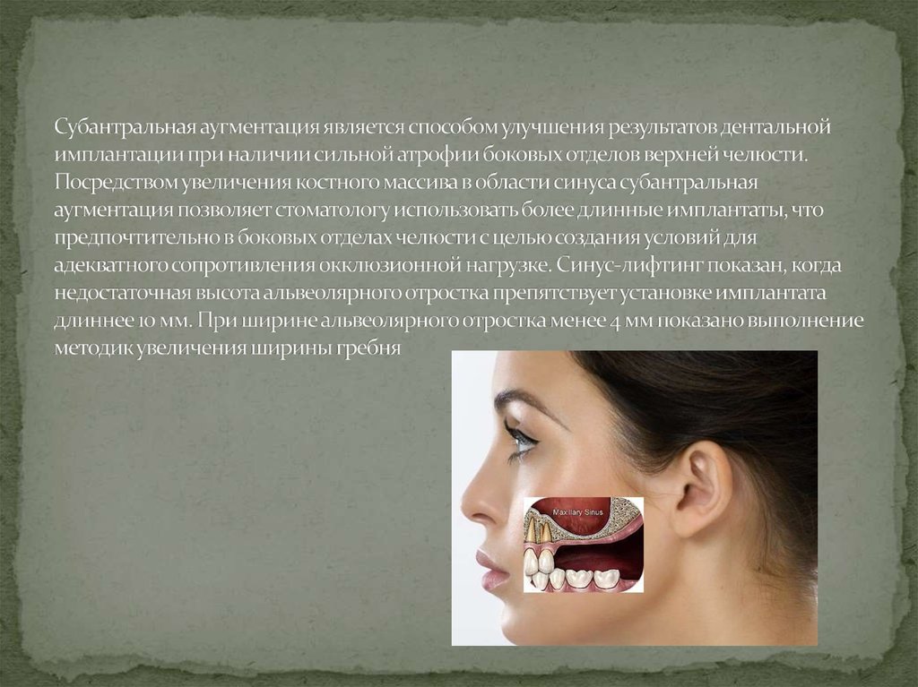 Субантральная аугментация является способом улучшения результатов дентальной имплантации при наличии сильной атрофии боковых