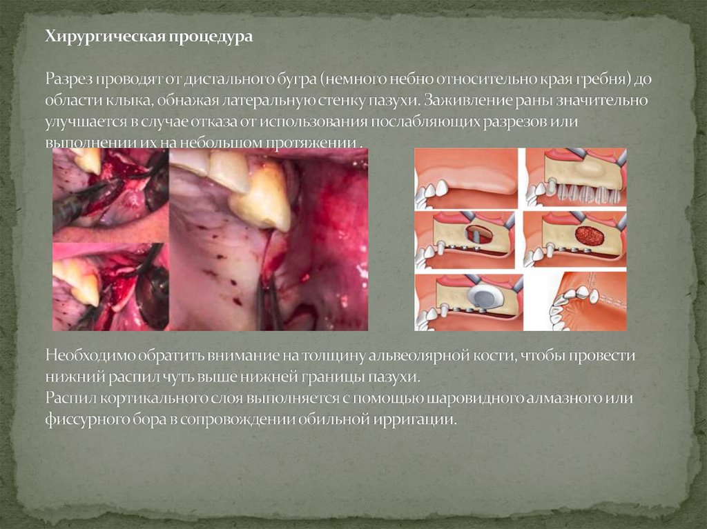 Хирургическая процедура Разрез проводят от дистального бугра (немного небно относительно края гребня) до области клыка, обнажая