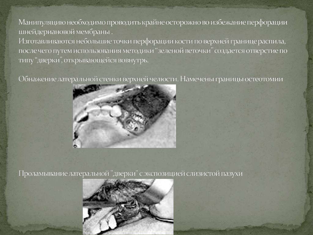 Манипуляцию необходимо проводить крайне осторожно во избежание перфорации шнейдериановой мембраны . Изготавливаются небольшие