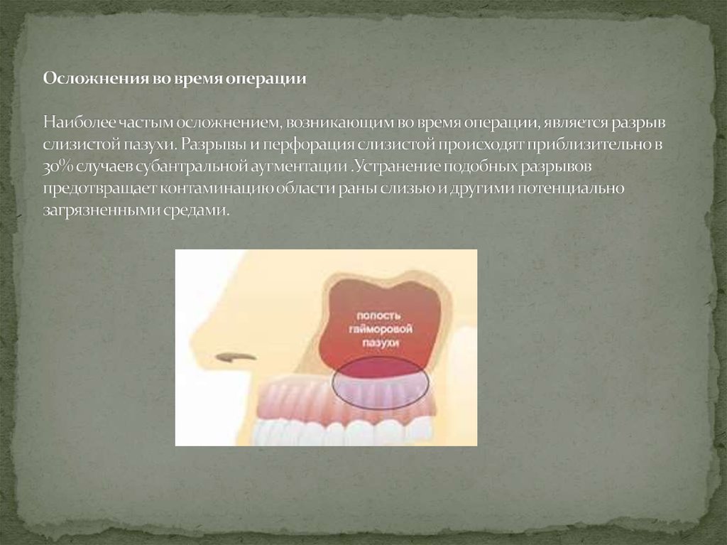 Синус операции. Осложнения синус лифтинга.