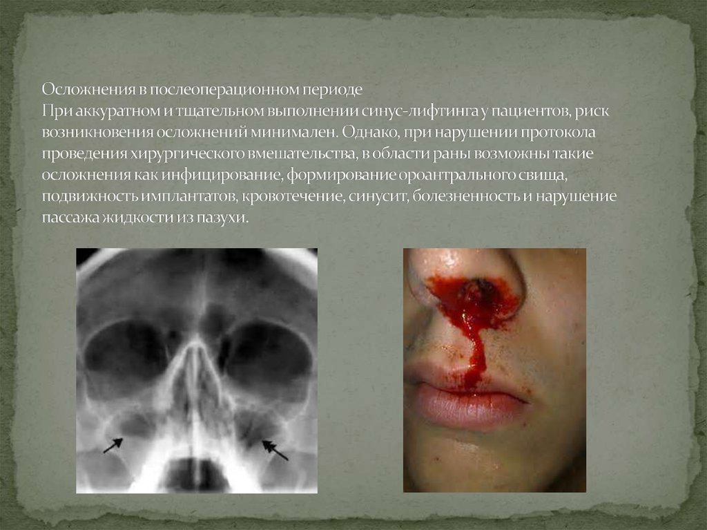 Осложнения в послеоперационном периоде При аккуратном и тщательном выполнении синус-лифтинга у пациентов, риск возникновения